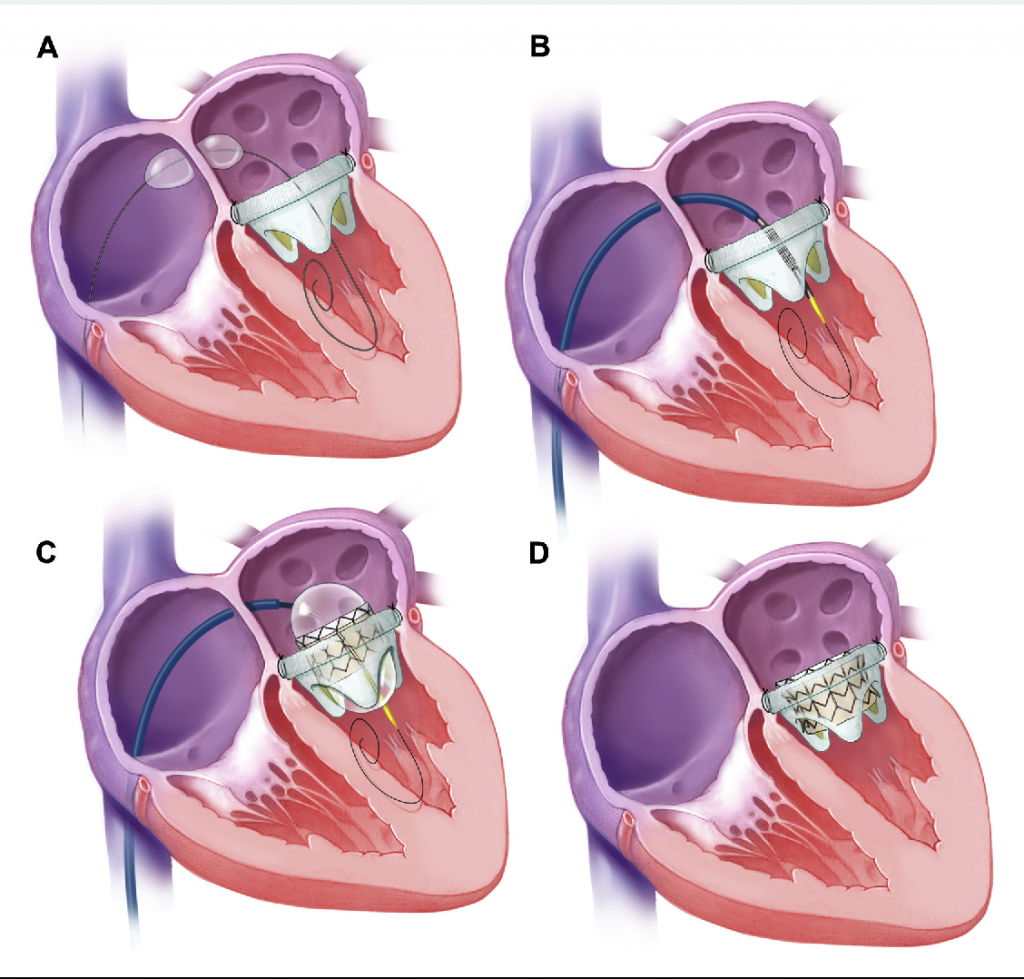 Митральный аортальный стеноз. Протезированный аортальный клапан. Эндопротез аортального клапана. Протез митрального клапана сердца. Аортальный стеноз протезирование клапана.